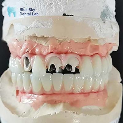 kaufen Titanium-Malo-Brücke Implantatbrücke ohne mehrere Einheiten Abutment Zement online manufacture