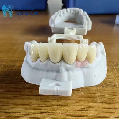 kaufen Hochdurchlässige Zirkonia-Kronen mit Implantatkrone online manufacture