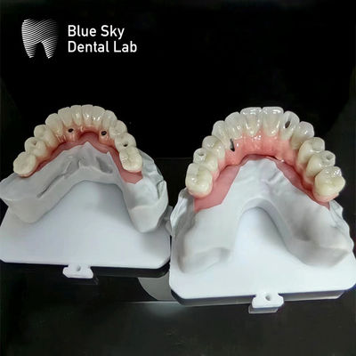 kaufen Implantate mit Blauem Himmel Vollbogen Implantatkasten Natur Implantatkasten online manufacture