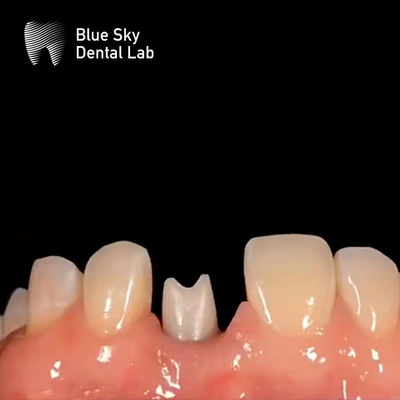 kaufen Hypoallergenes Zahnimplantat Zirkonia Abutment Biokompatibel online manufacture