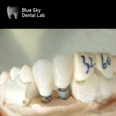 kaufen Einzelkronen Zirkonia Abutment Hypoallergene Zahnimplantate Zirkonia Abutment online manufacture