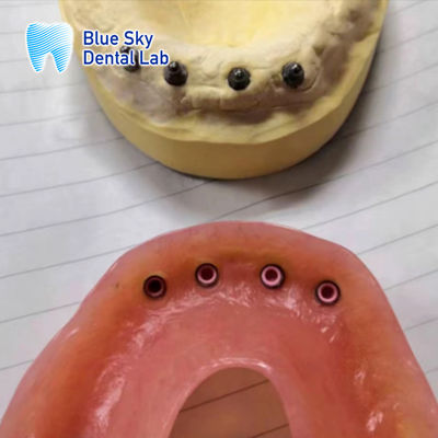 kaufen Abnehmbare Implantat-Restaurierungs-Locator Implantat-Pflege Vollmunterrestaurierung online manufacture