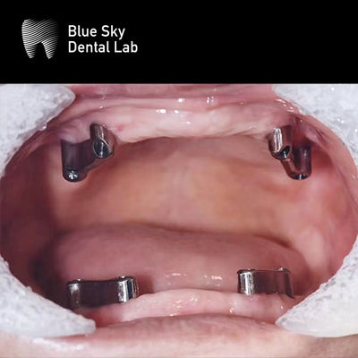 kaufen Implantate aus Harz Zahn Zahn Titanstahl Abnehmbar Blauer Himmel online manufacture
