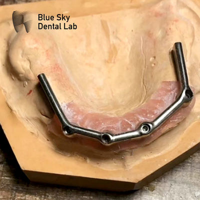 kaufen Voller Oberzahn Titanstahl Voll Mund Restaurierung Blauer Himmel Implantat online manufacture