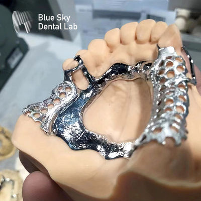 kaufen Blauer Himmel Zahnrüstung Teilweiser Kieferprothese Gusseisenrahmen online manufacture