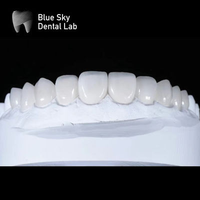 Schlanke Premium Veneer-Gehäuse 0,3 mm Ultra dünne Emax-Feneren