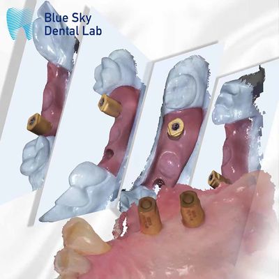 Scan Körper All-in-One Zahnheilung Kapsel Blauer Himmel Implantat System