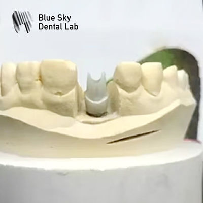 Ästhetische Zirkonia Abutment Implantat Biokompatibel Präzisionsfräsen