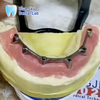 Titanstahl-Overdenture-Removable-Implantat mit Überdenture