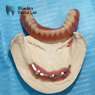 Blue Sky Implantat Titanstahl Zahnpflege für Implantatpräparate